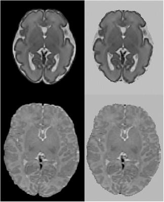 Characterization of dynamic patterns of human fetal to neonatal brain asymmetry with deformation-based morphometry